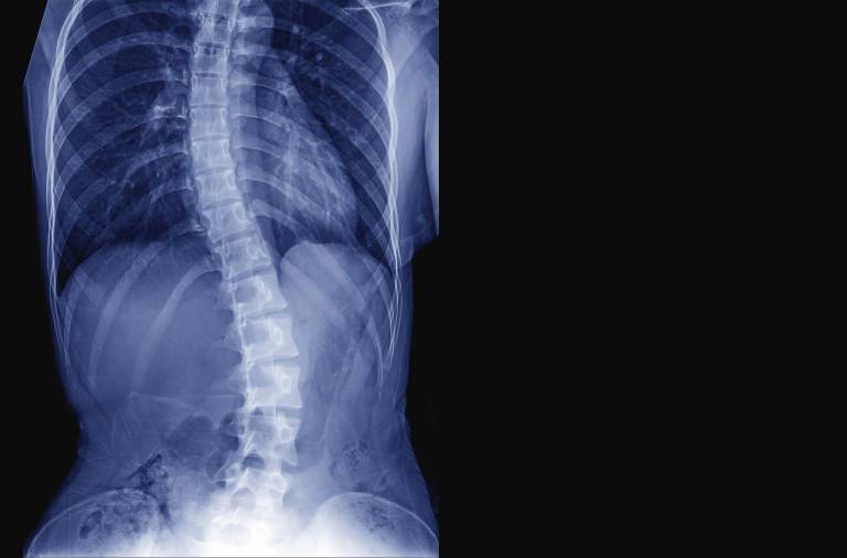Scoliosis Treatment & Surgery in Singapore