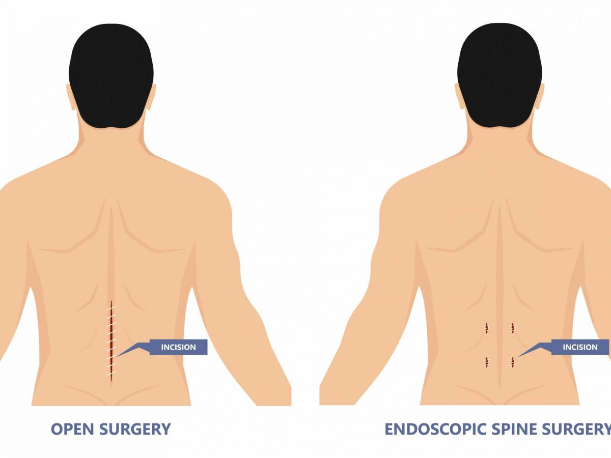 open spine surgery