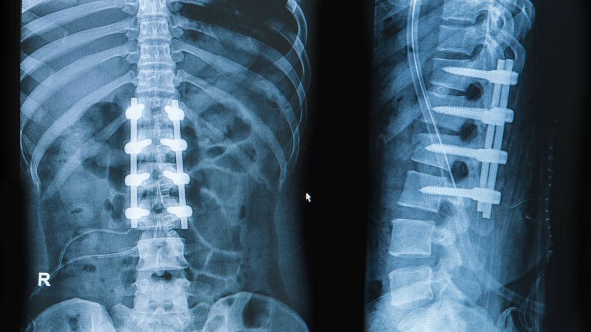 Lumbar Spinal Fusion Surgery Singapore | Achieve Spine