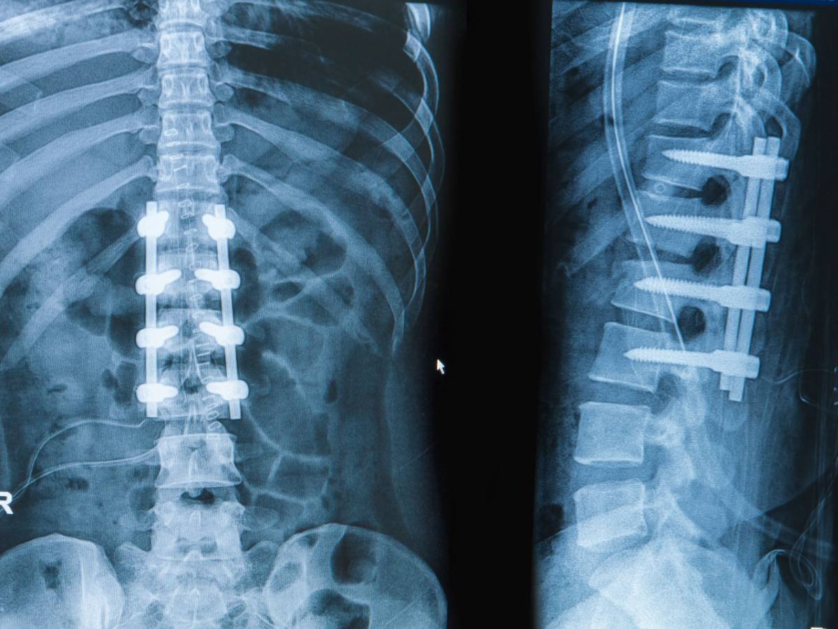 Lumbar Spinal Fusion Surgery Singapore | Achieve Spine