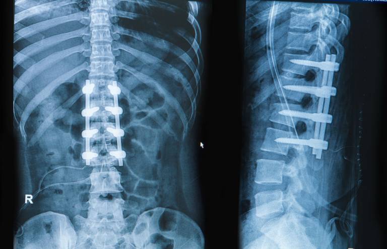 spinal-fusion-singapore
