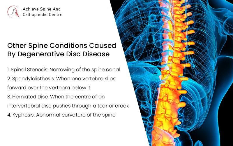 Other spine conditions caused by degenerative disc disease