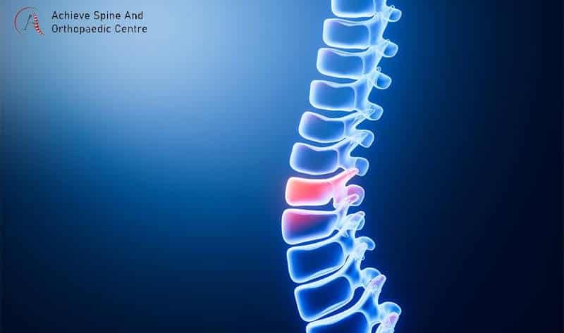 Illustration of a herniated or bulging spinal disc.