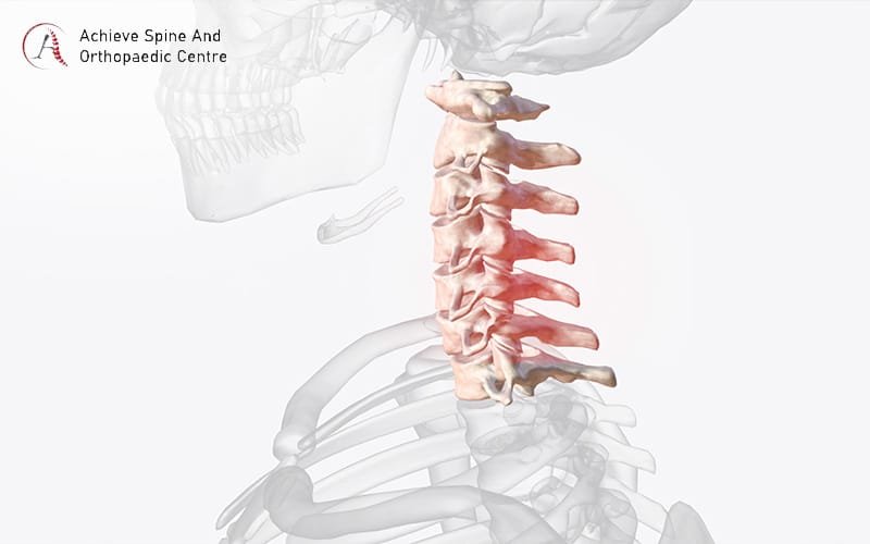 Illustration of cervical osteophytes on the spine