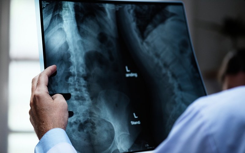 Medical professional reviewing back X-ray for spinal fusion complications.